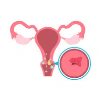 Cervical traction in English