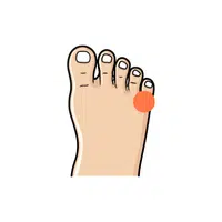 Little toe